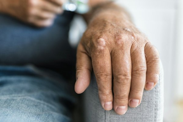 What's the Current Understanding of Environmental Triggers for Psoriasis Flare-Ups?